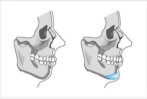 所以要通过截断部分的颏骨,通过前移再固定的方式改善下巴形状.