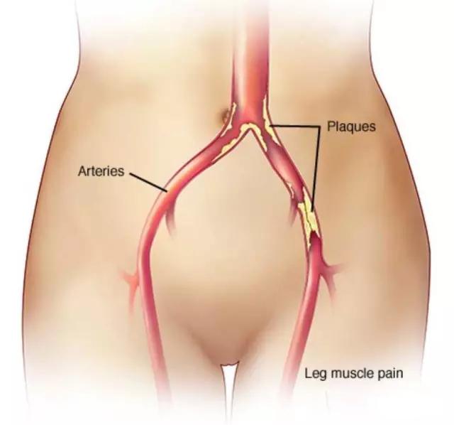 有时候腿疼可不简单，也许是外周血管出现了问题，进来看看吧