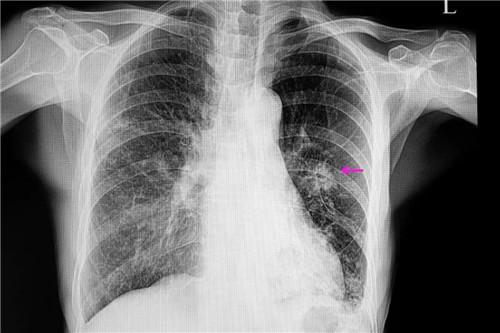 肺结节=肺癌吗?