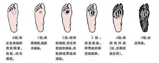 你永远不会想百度的糖尿病足，看这里就能了解
