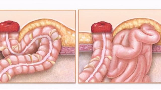 小肠造瘘手术图解图片