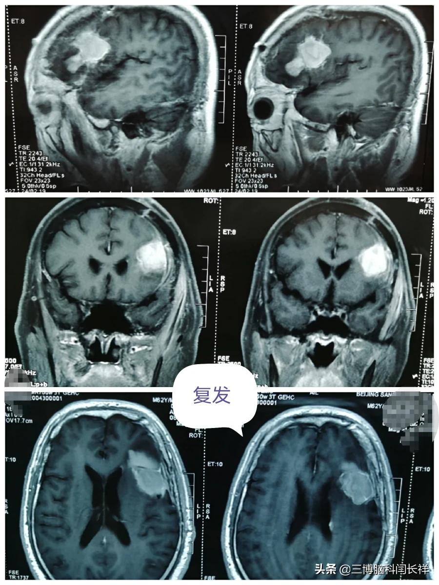 胶质瘤4级术后两个月复发,原因令人捶胸顿足_胶质瘤_胶质瘤治疗方式