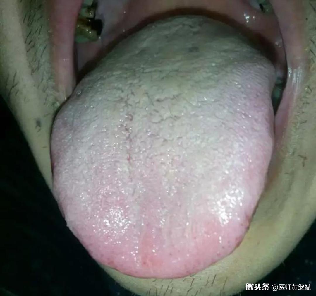 脾胃有湿热的舌象图片图片