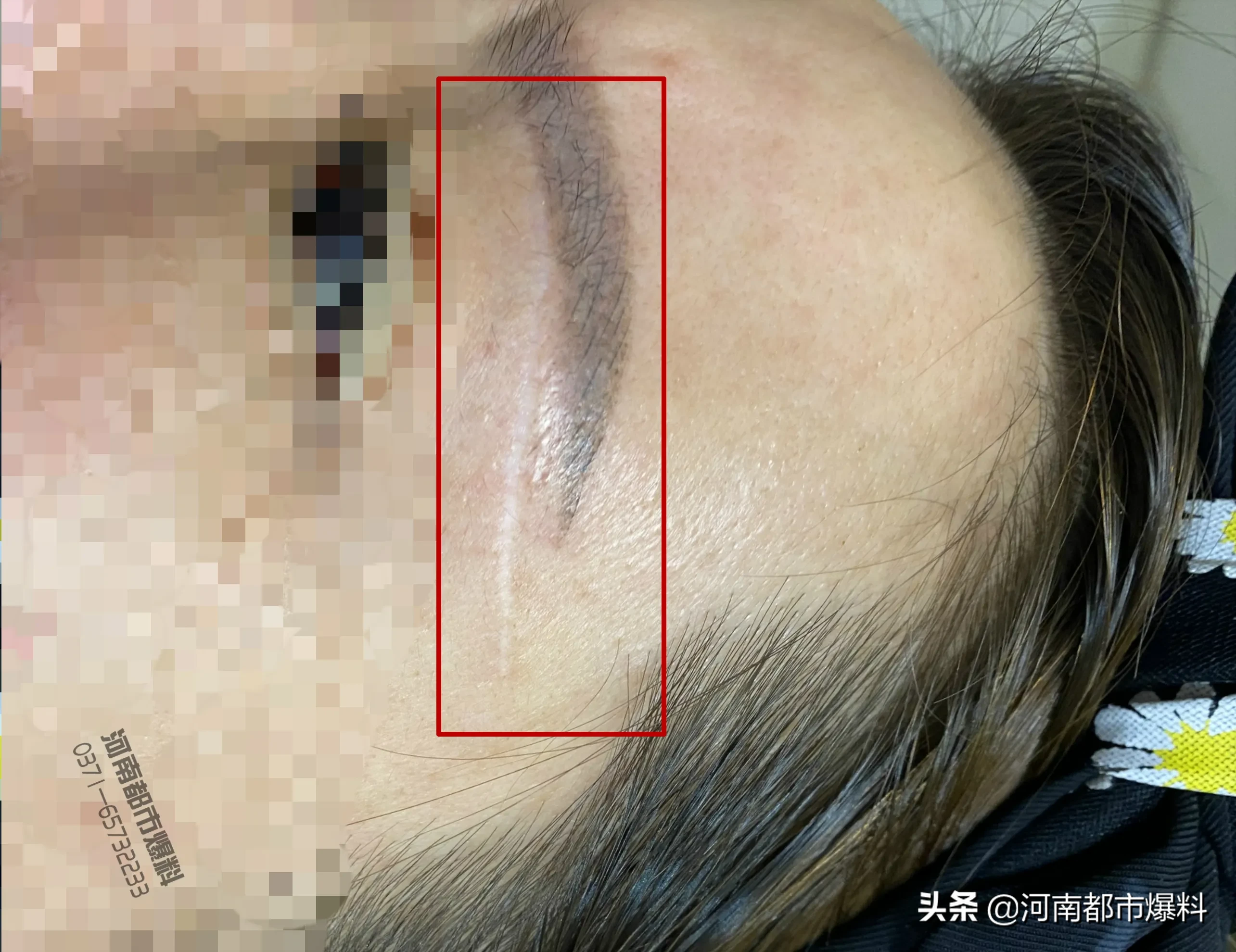 提眉手术留疤痕，修复一年没好转！郑州爱美丽医疗美容门诊部：她没有眉毛遮盖！