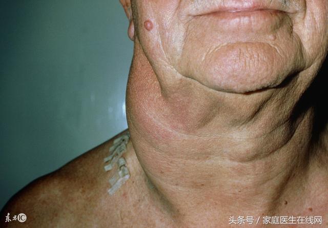 恶性淋巴瘤早期有这5个症状,随便忽略哪一个,后果都严重_健康症状网