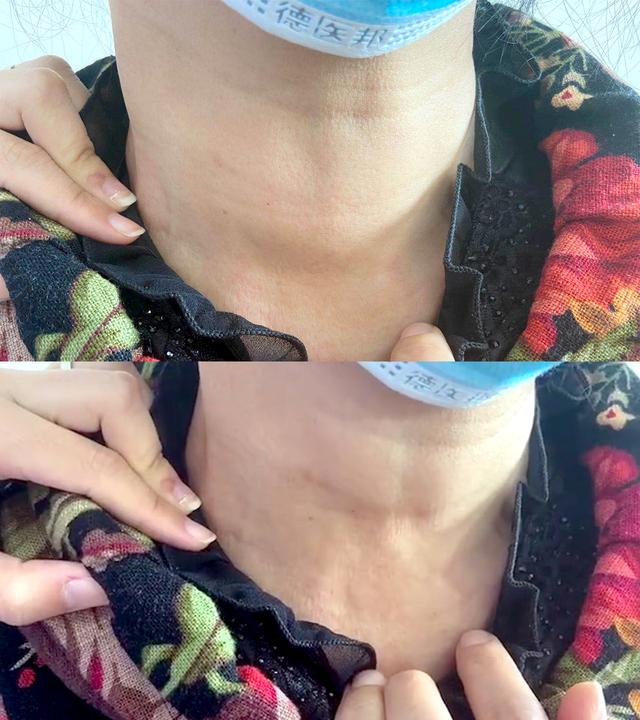桥本甲亢加甲癌!脖子肿的像鸡蛋,患者哭诉我怎么突然得这么多病