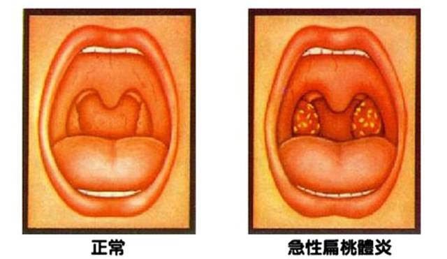 扁桃体其实有三种:腭扁桃体,咽扁桃体和舌扁桃体.