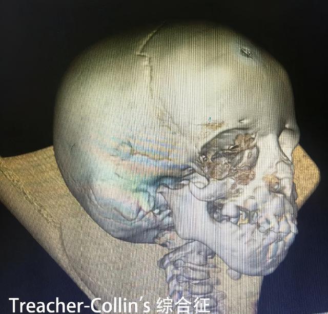 像鸟头一样的treachercollins综合征患儿