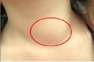 颈部甲状腺肿大症状的症状及缓减治疗方法_乐启网络健康症状网