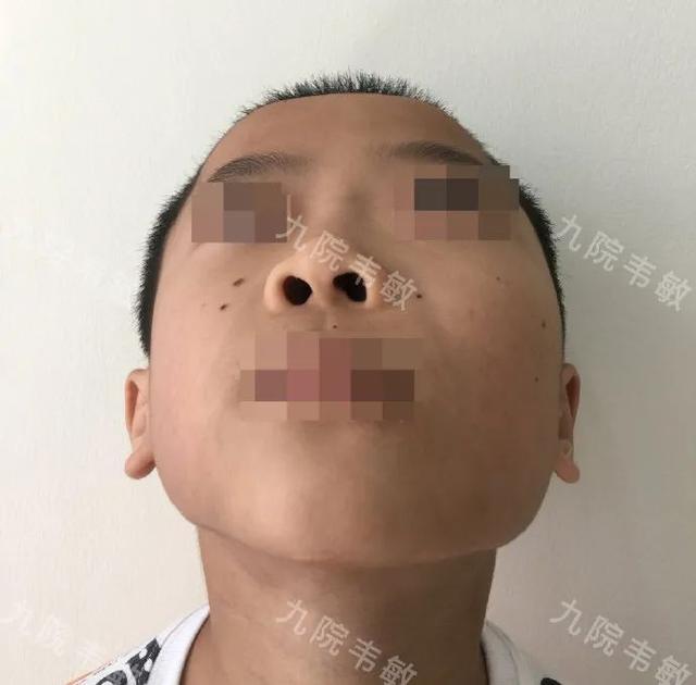 骨纤维异常增殖症患儿诊疗记录