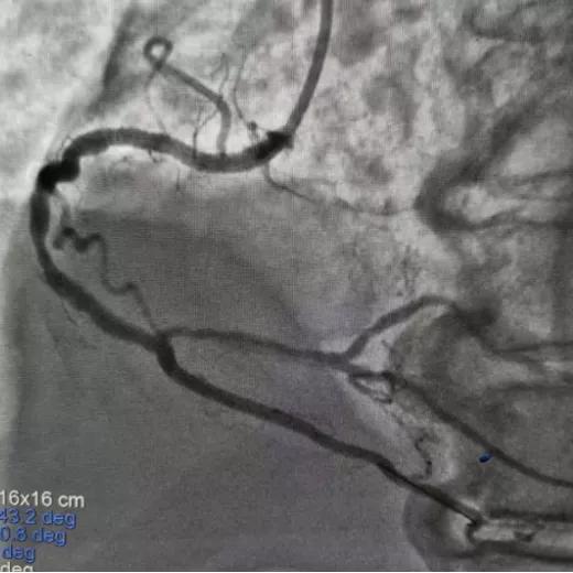 阜阳市妇女儿童医院胸痛中心成功救治 83 岁高龄急性心肌梗死患者