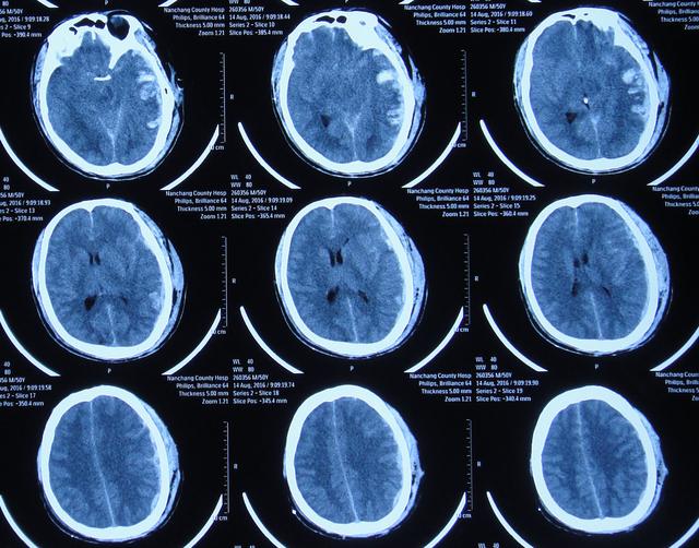 车祸脑外伤脑积水性脑膨出,外院7个月内4次住院治后脑积水脑膨出无