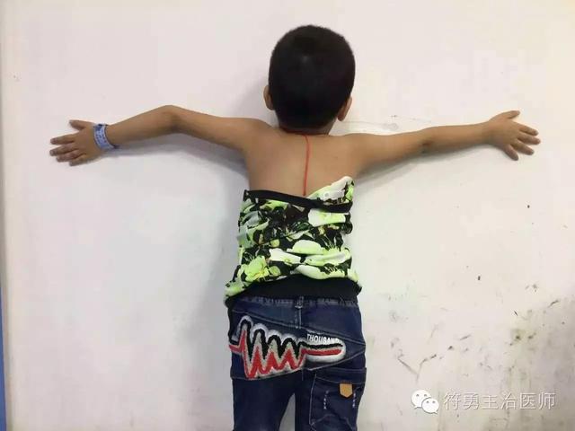 肘内翻矫形手术