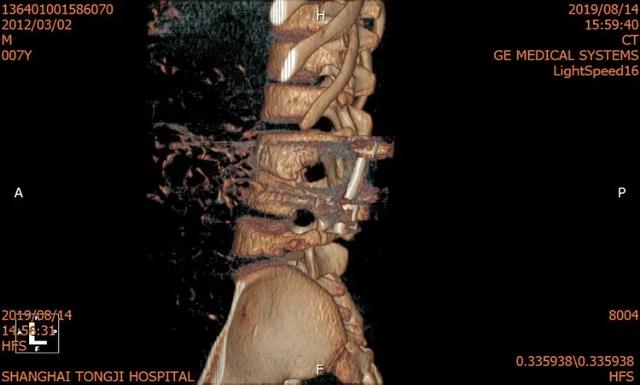同济大学附属同济医院成功救治一例复杂儿童腰椎半椎体畸形