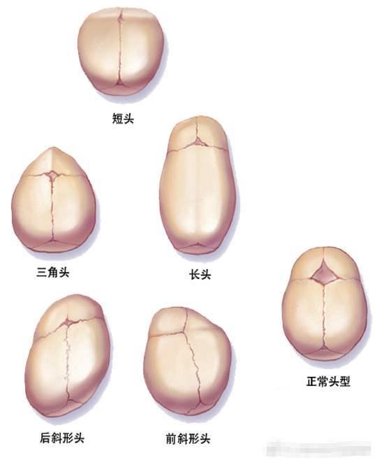 小儿头型异常不可轻视,颅缝早闭的判断与治疗_狭颅