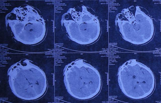 車禍腦外傷開顱後腦膨出顱內感染和腦積水致偏癱在李小勇腦脊液科治