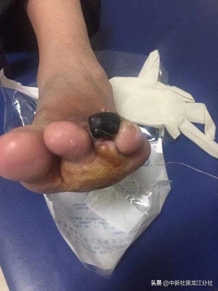 鞋子挤压脚趾甲发黑的症状及缓减治疗