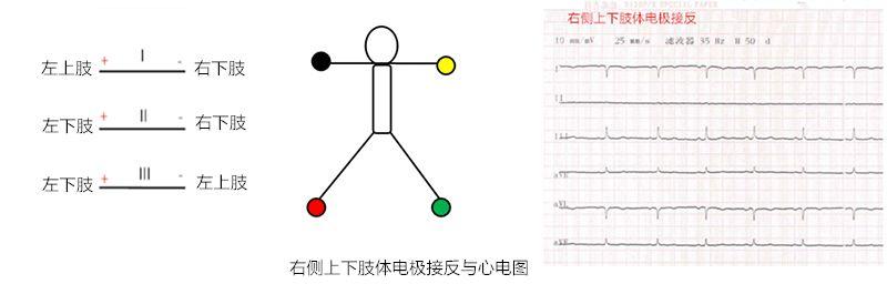 干货肢体导联电极错接的心电图分析及鉴别上四夹子导联