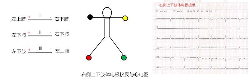 心电图四肢导联英文图片