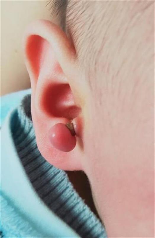 孩子长了附耳怎么办?家长用头发丝用线各种缠断,医生喊stop