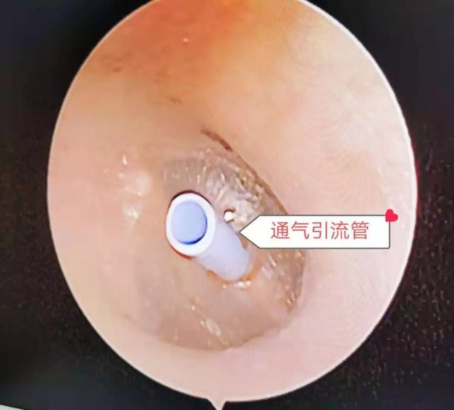 耳朵里的排水管