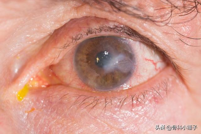 角膜炎的症状及缓减治疗方法_健康症状网