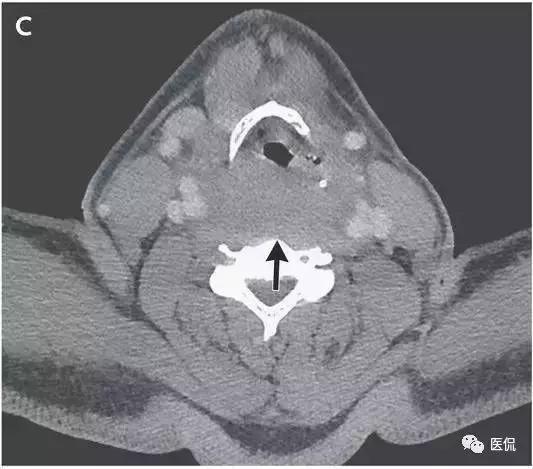 x线发现咽后壁发生肿块为什么又做了ct