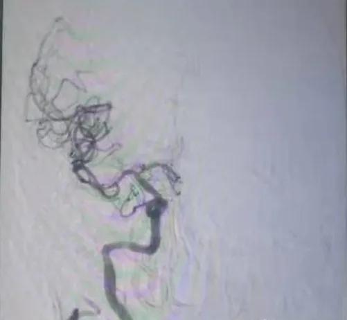 【关注】72 岁张大伯突发中风，紧急转院，老伴在手术室前说出了这句