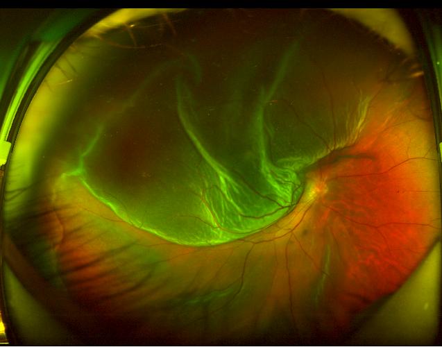 杭州爱尔争分夺秒24小时内完成孔源性视网膜脱离手术救治
