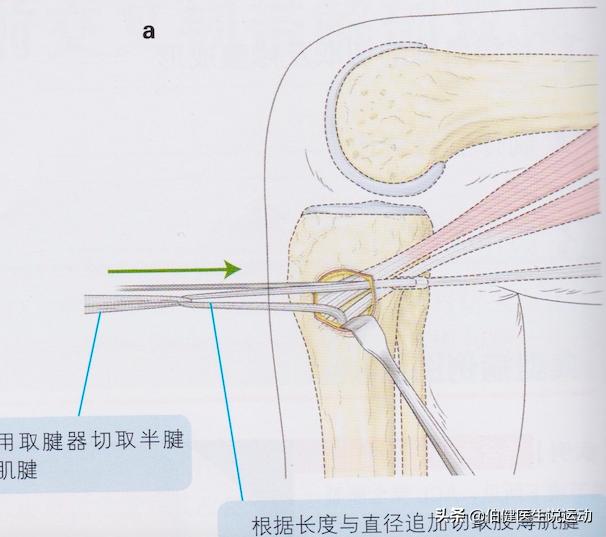膝关节前交叉韧带关节镜下自体腘绳肌腱重建手术过程介绍