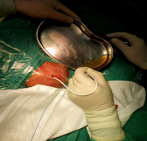 微创ommaya囊治疗新生儿脑积水广西妇幼保健院罗树友副主任医师为