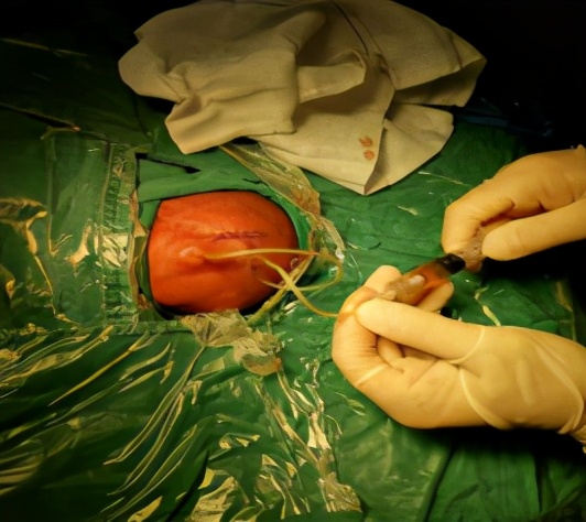 微创ommaya囊治疗新生儿脑积水广西妇幼保健院罗树友副主任医师为