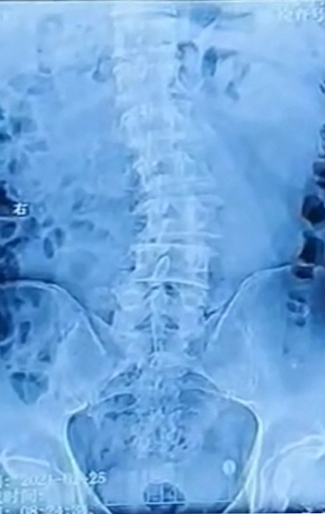 腰椎的下腰区出现一个向左侧的侧凸,腰椎2/3,3/4,4/5都有不同程度的退